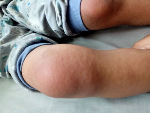 Gatal gatal anak 5 tahun apakah campak?