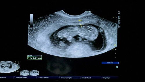 Icsi ตรวจโครโมโซมตัวอ่อน