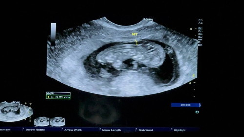 Icsi ตรวจโครโมโซมตัวอ่อน