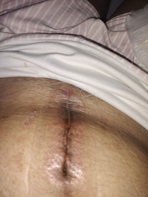 (Cs) namumula at nangangati ang tahi normal ba?