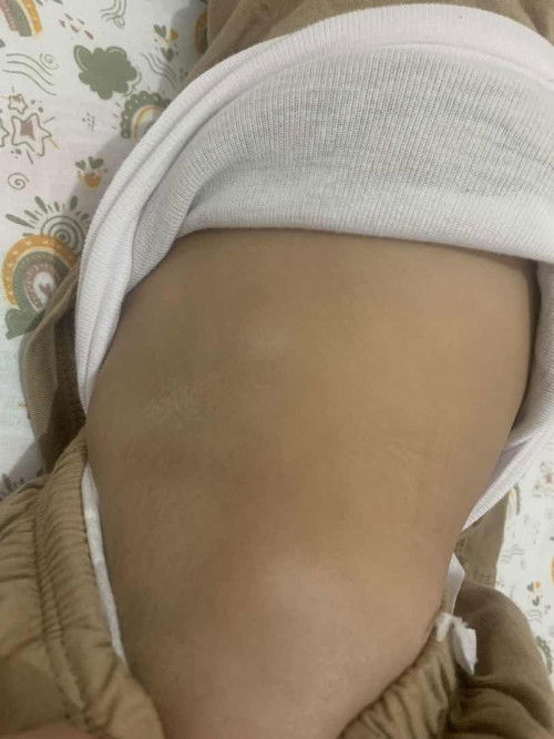 Sharing dong bunda bunda ada yg anaknya putih2 di punggung ga ? Sembuh nya pakai apa ya?