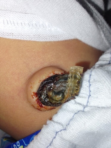 Umbilical cord