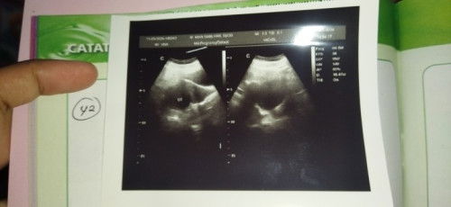 Hamil 6w keluar darah