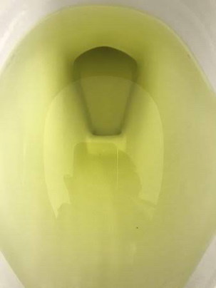 Lime green pee normal po ba?