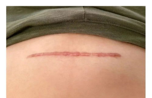 Bekas jahitan sc