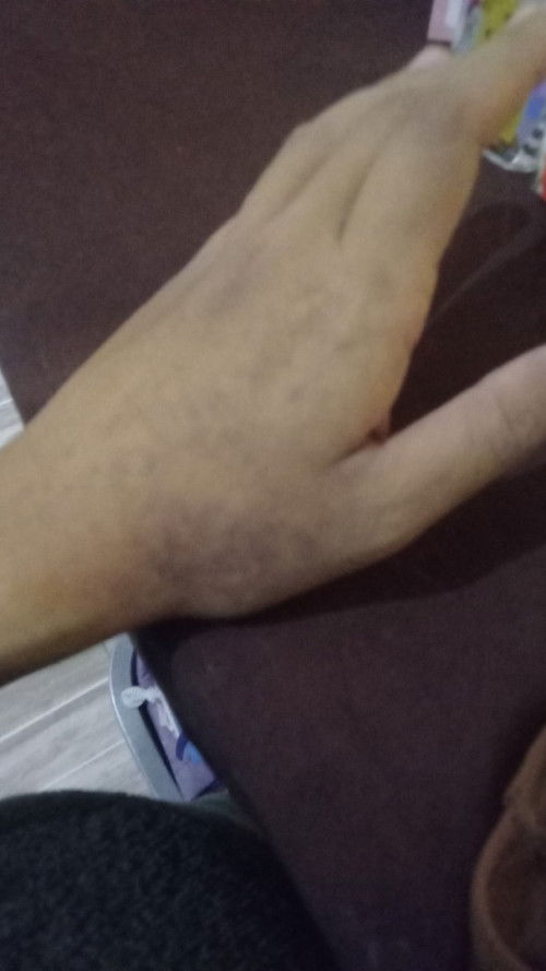 Bintik hitam ditangan.