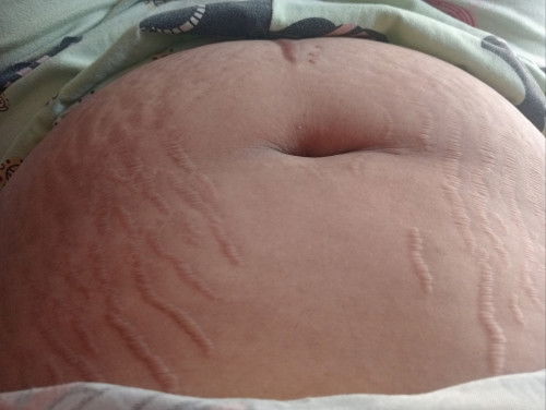 ทำยังไงให้หายเป็นแผลเป็น