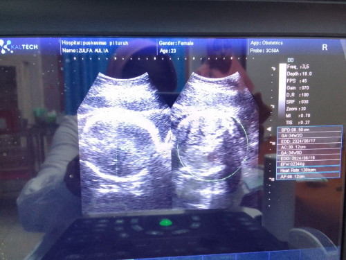 Ada yang bisa baca hasil USG bunda",kira" saya perkirakan lahir menurut USG kapan ya Bun