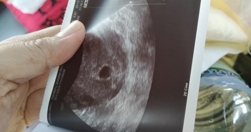 gestational Sac pa lang, normal ba? April 1 po last mens ko. First time mama po. Pls enlighten me.