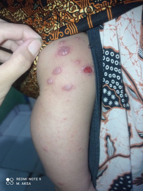 Salep apa ya bun untuk kayak gini?