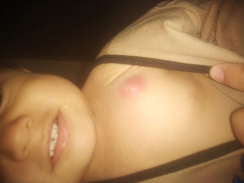 Bisul atau apa ya mom...