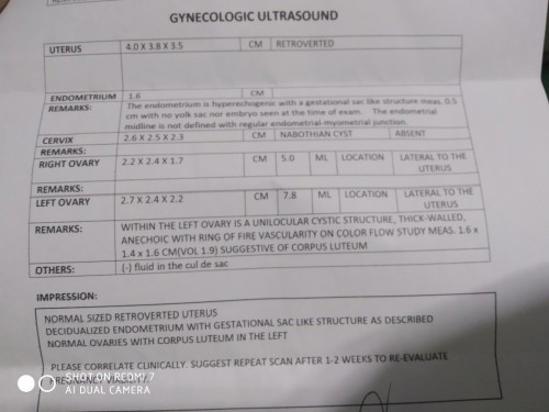 Ectopic ba????
