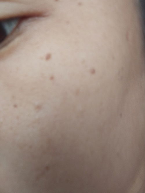 bintik coklat di wajah seperti kutil