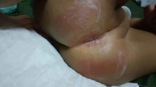 anak saya 7 bulan ..
brapa2 hari n dy berak n punggong dy jd mcm n..ada ke sapa2 taw apa blh saya bt