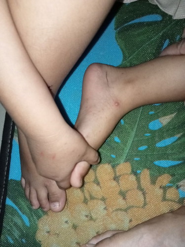 Ini apa cacar ya.? Kok kakinya bintik-bintik trus berair. Gatel kata anak