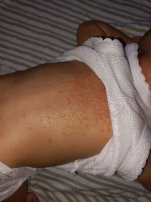 Bruntusan atau ruam? pada bayi