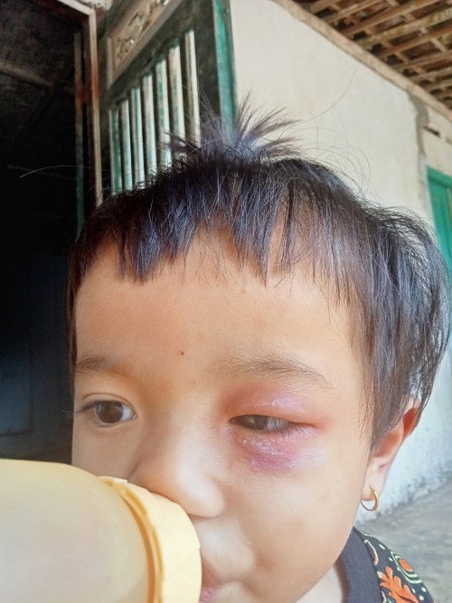 Bengkak di mata dan ada bintik putihnya