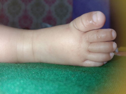 Bintik merah dikulit