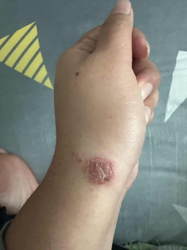 Eczema yang teruk