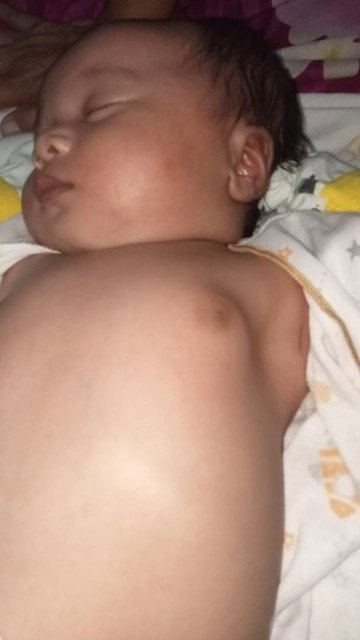 Benjolan pada payudara bayi