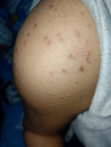 Mau tanya ,, ada yang sama gak ya TM3 badan pada gatel semua,trs muncul bintik2 merah kaya campak ?