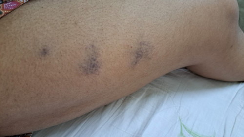 Injection 💉, cairkan darah lepas Czer suntik sendiri untuk 30 hari