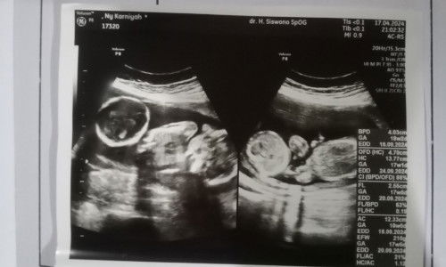 Nutrisi yang di butuhkan untuk janin kembar