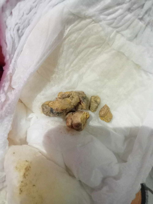 น้องอึแข็ง เป็นกับนมผงไหมค่ะ