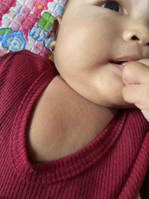 Ruam bruntusan setelah di oles c3ssa biru