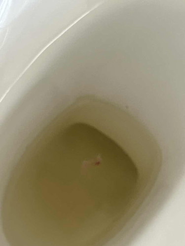 Blood-tinged discharge in pee
