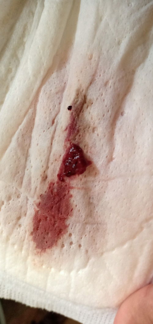 Keluar darah sehabis cek pembukaan