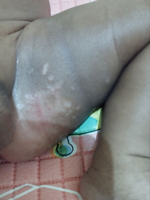 Hallo mom, ada yg mengalami kasus serupa ga ya? Bayiku ruam pas sembuh jd spt itu dan muncul ruam lg