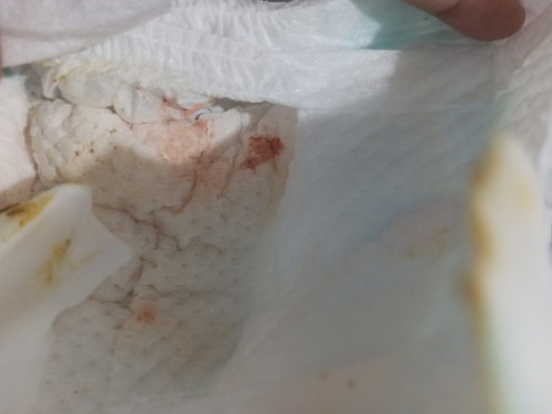Blood urine newborn