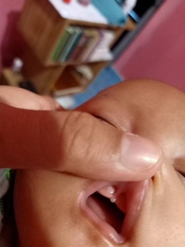 Lip tie atau bukan