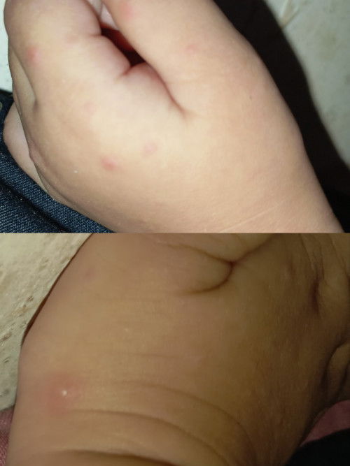 Telapak tangan bintik merah dan berair