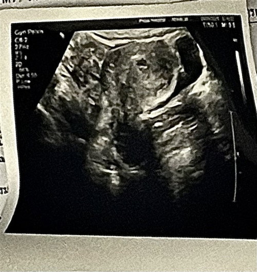 6w+1 ยังไม่เจอตัวน้อง ตกไข่ช้าหรือป่าวคะ🥹