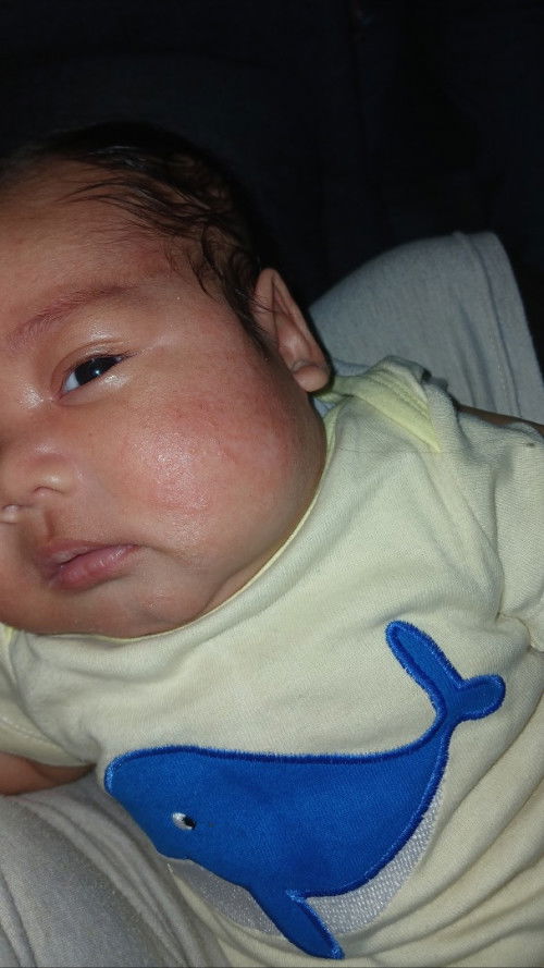 Pipi merah pada bayi