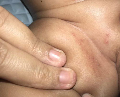 Selangakangan bayi merah kaya jerawat