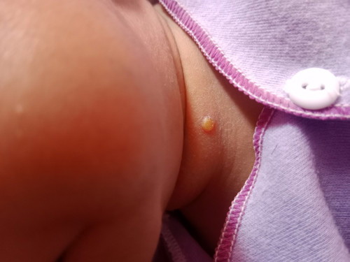 Bun saran nya dong pke obat apa ya ko pada melenting trs di dlm nya kya ada nanah nya gitu🙏