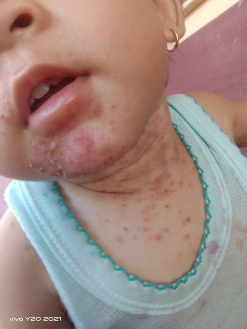 merah dan luka pada bayi