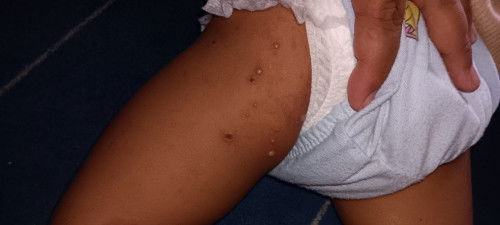 Bintik² merah ada cairan dan nanah, umur 1 thn gak sembuh² udh 5minggu lebih