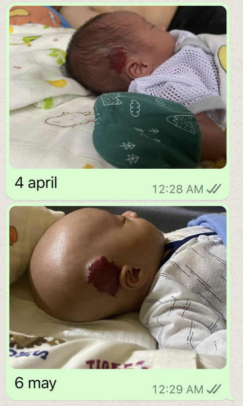 Stawberry birthmark Baby Premature