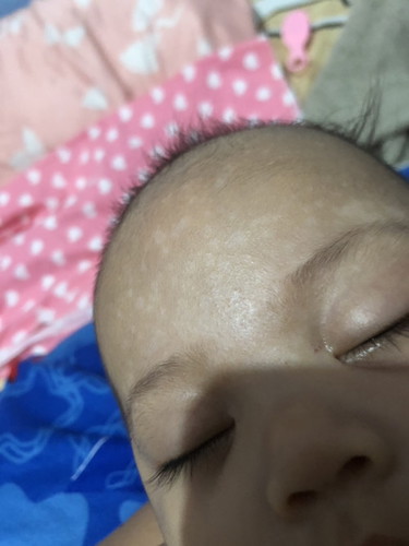 Puti puti sa noo