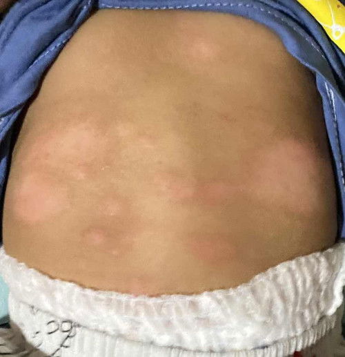 Sudah periksa ke dr kulit tapi belum ada perubahan