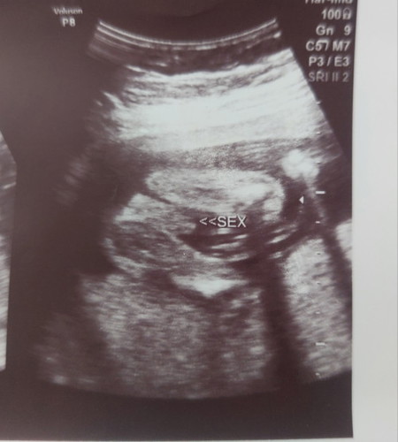 GENDER ULTRASOUND