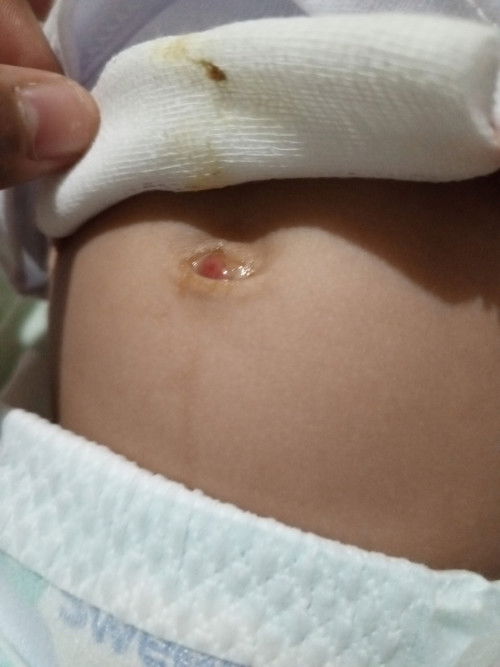 Sudah puput puser tapi masih ada benjolan dan puser masih basah.