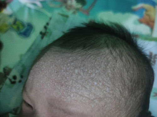 Bintik bintik di kepala kening