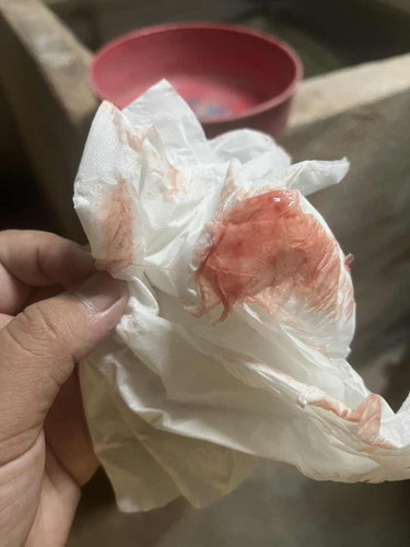 38+4แบบนี้เรียกมูกเลือดใช่มั้ยคะ