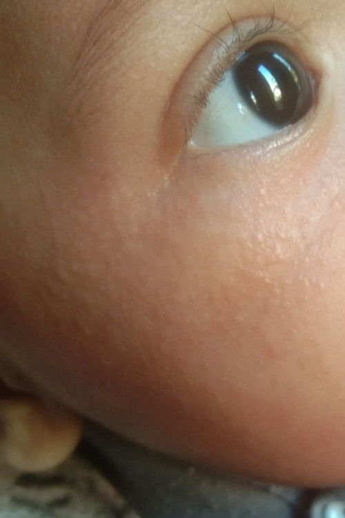 Bun, anaknya ada yang pernah gatel kek gitu ngga? 😥