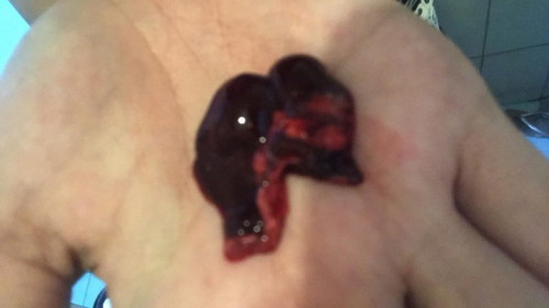 7weeks miscarriage